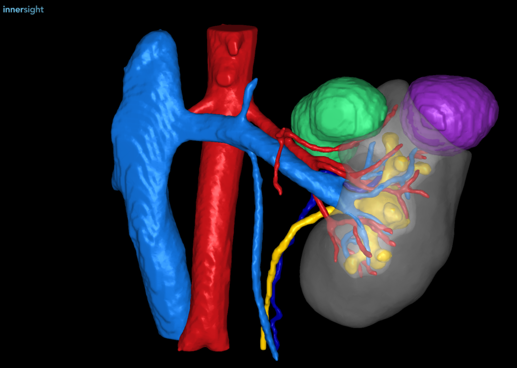 A 3D modelling image of a tumour